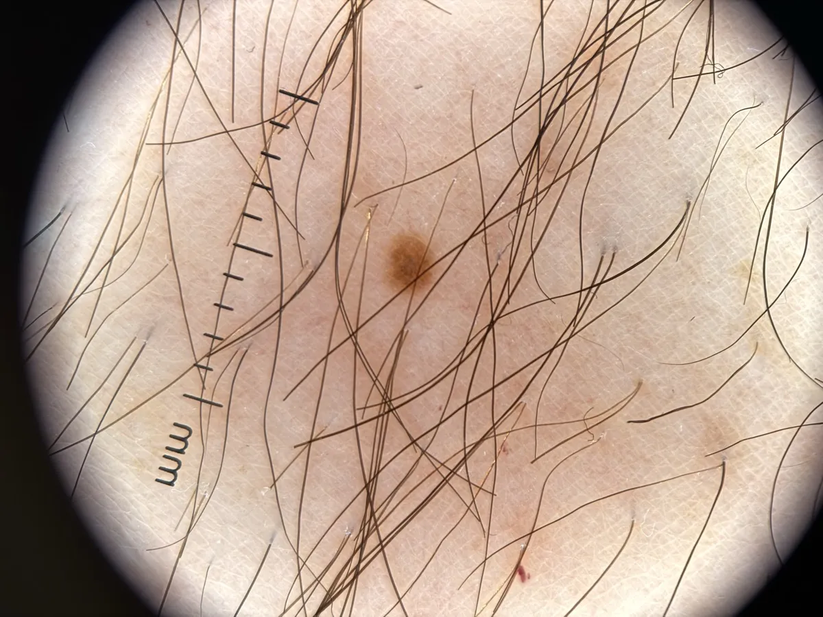 Dermatoskopibild av ett pigmenterat märke med mm-skala