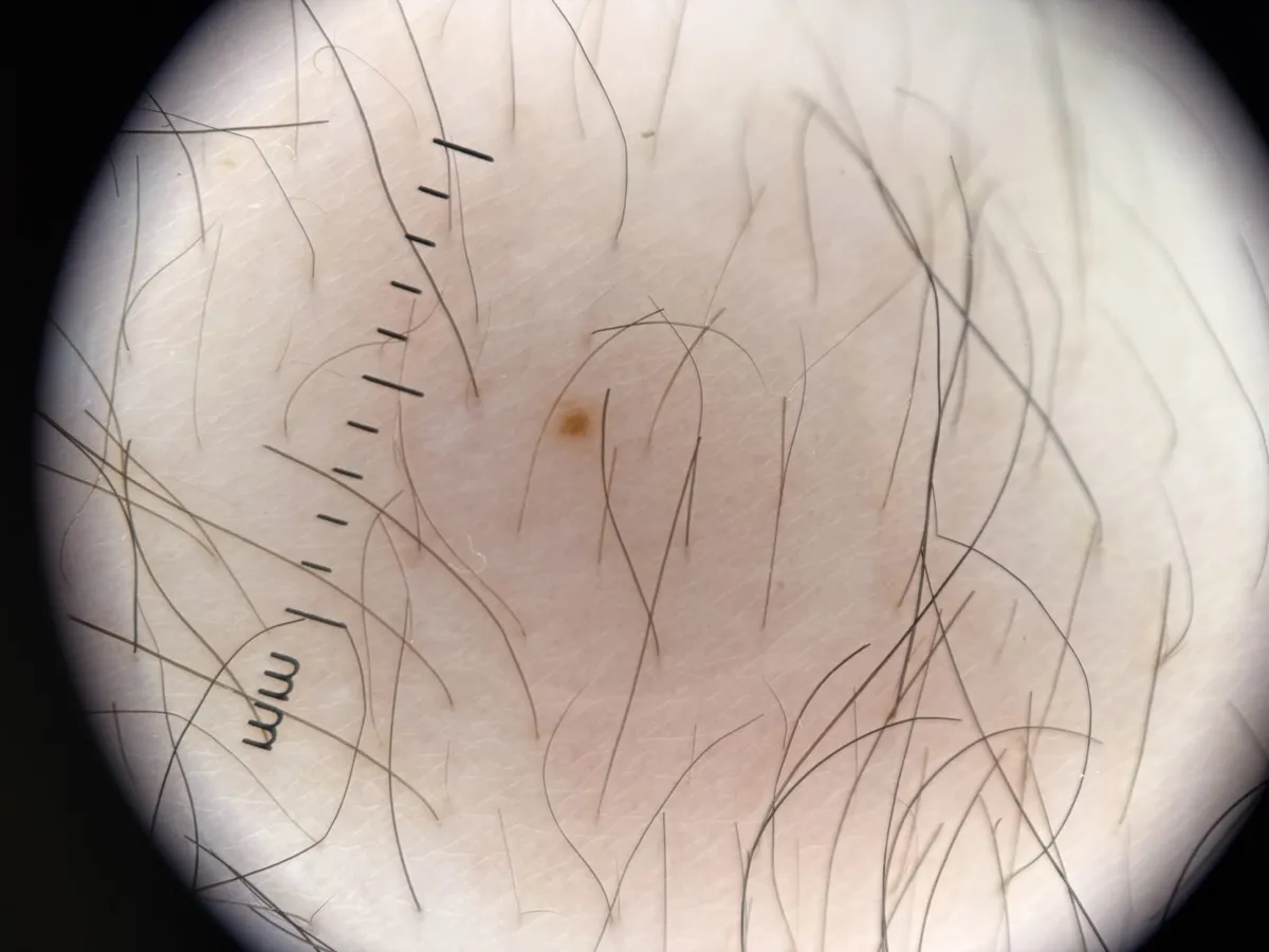Dermatoskopibild av ett ljusare märke i hårbevuxen hud
